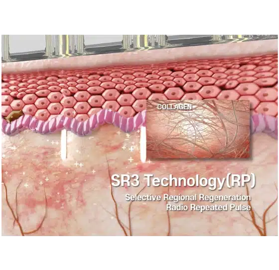 FIT9|RF Microneedling